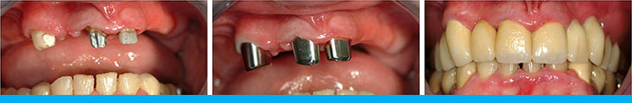 Telescopic Dentures - Before During After
