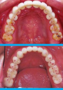 Bite Adjustment - Occlusal Adjustment - Spot Grinding