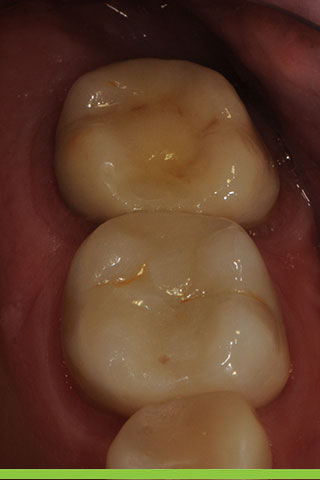After - natural molar