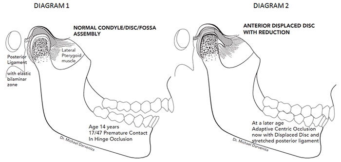 Orthodontic Splint for Grinding Teeth - Haas Orthodontic Arts