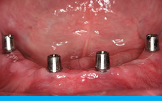 SynCone abutments for hygienic implant denture