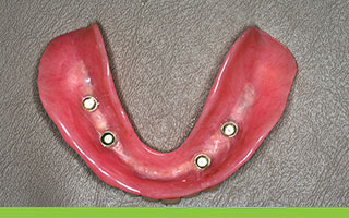 SynCone lower implant denture made of acrylic resin