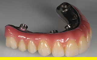 HotBonded titanium / zirconia All-on-4 Prettau Zirconia implant denture