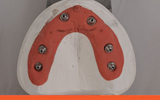 Plaster model of upper jaw for All-on-6 implant denture