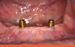 Implants with abutments
