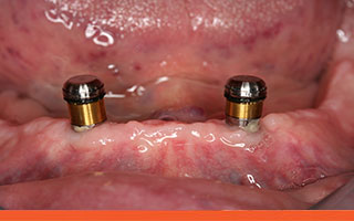 Locating attachment with o-rings for the denture
