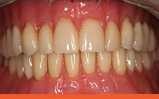  Resin implant dentures
