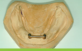 Retentive gold bar linking two implants
