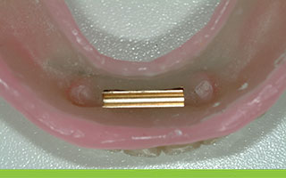 implant denture with retentive gold sleeve 