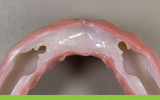 Prettau Zirconia All-on-4 implant denture