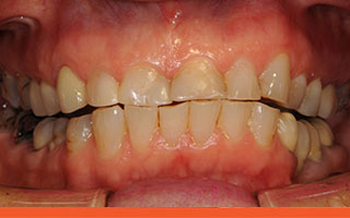 Short worn damaged angled teeth