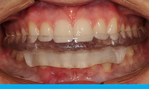 Fully Protective Occlusal Splint in protective hinge closed bite 