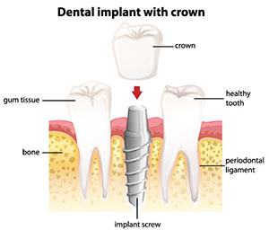 Crowns On Dental Implants